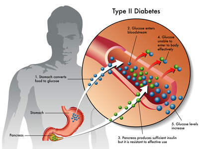 diabetes weight loss can help manage the condition